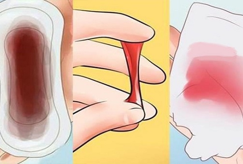 Băng vệ sinh giả - Nguyên nhân gây ung thư cổ tử cung